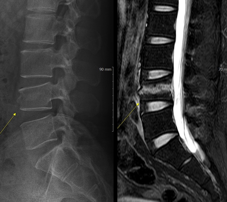 압박골절 엑스레이와 MRI