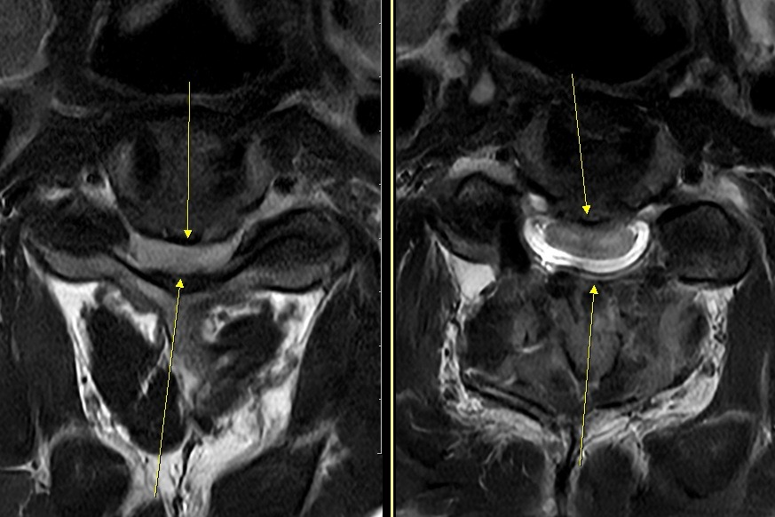 경추 감압술 전후 축면 MRI