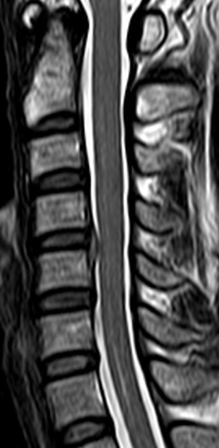 디스크가 보이는 경추 MRI