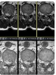 디스크 재파열 부위 MRI