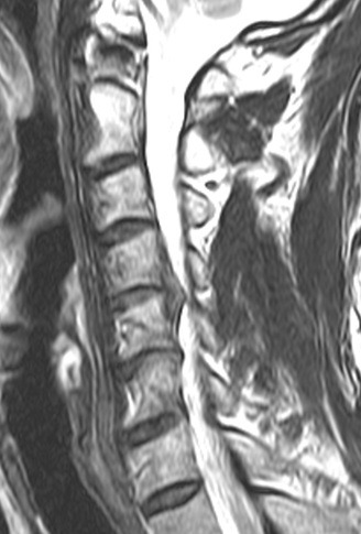 경추 MRI, 파열된 디스크 부위