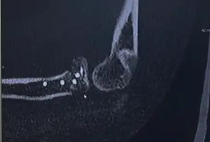 수술 후 팔꿈치 CT