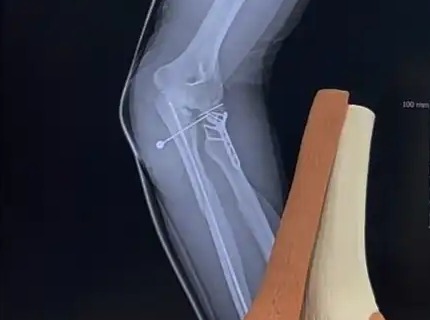 수술 후 팔꿈치 엑스레이