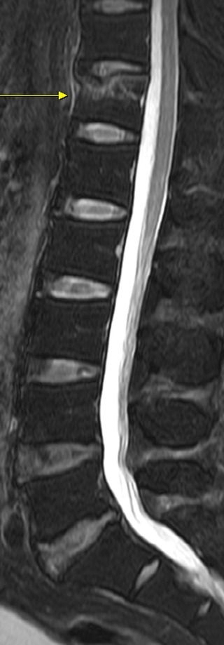 척추골절이 확인된 MRI