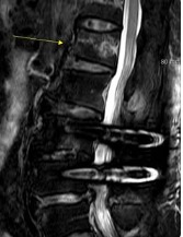 급성 압박골절이 확인된 MRI