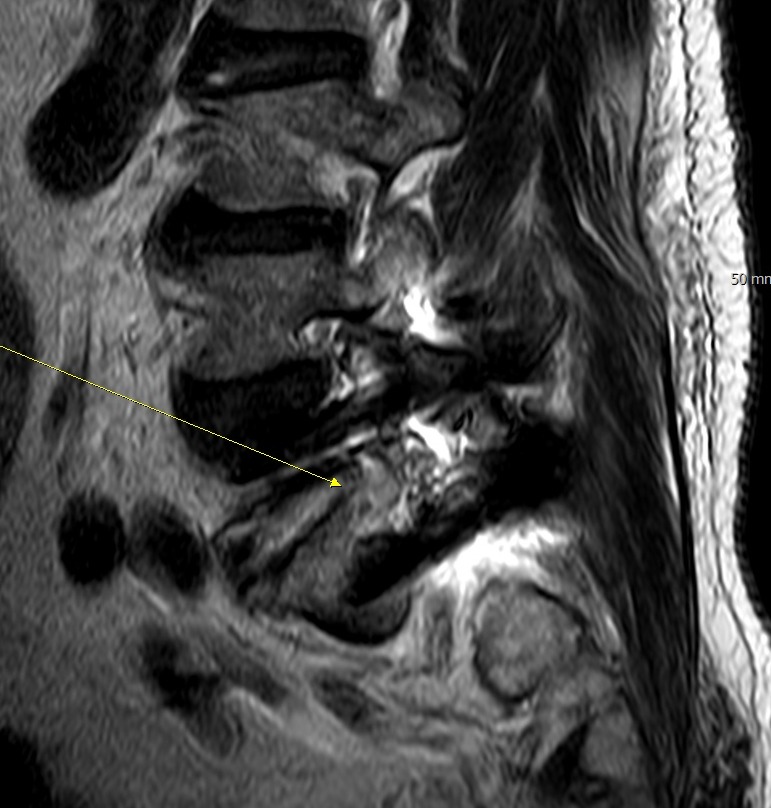 수술 후 MRI