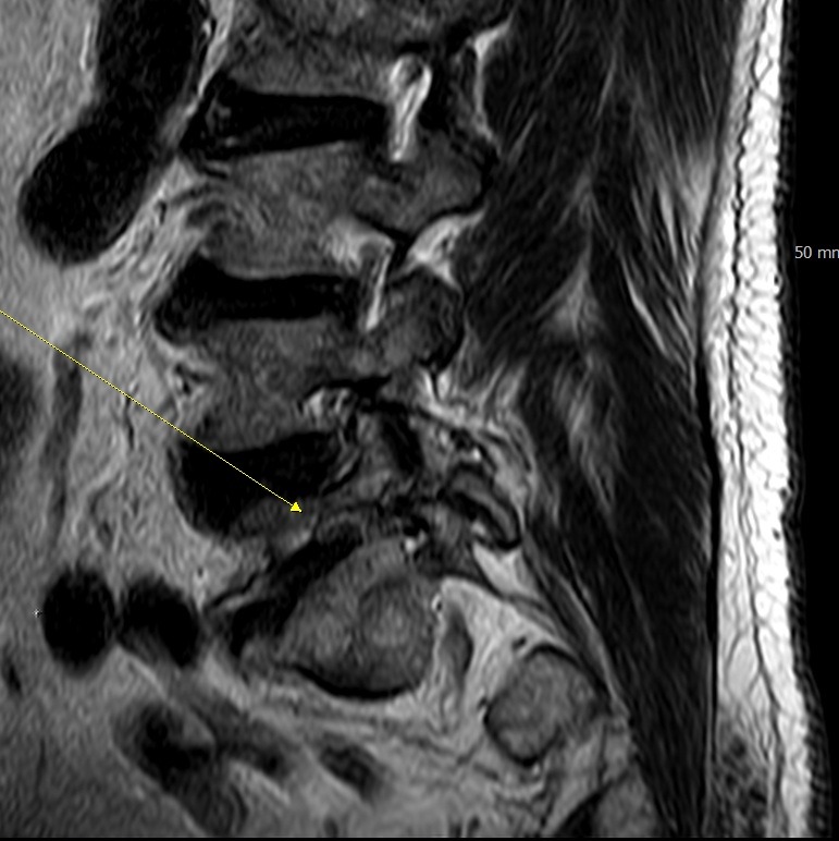 수술 전 MRI, 신경근이 눌리던 부위