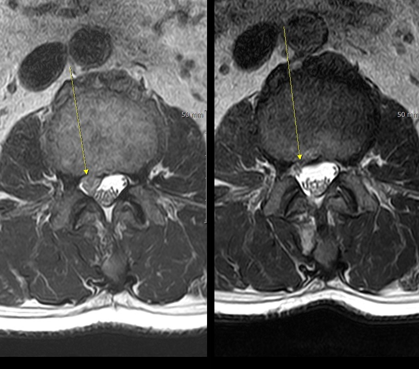 내시경 디스크 제거술 전후 축면 MRI