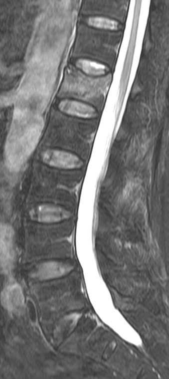 급성 압박골절 MRI