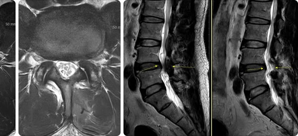 양방향 내시경 감압술 후 MRI
