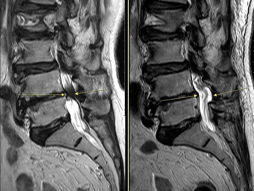 요추 4/5번 척추관협착증 양방향 내시경 감압술 전후 시상면 MRI