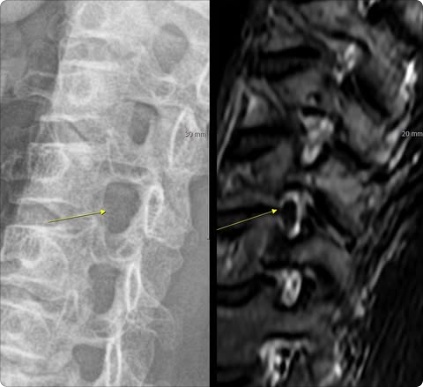 정상으로 보이는 경추 엑스레이와 디스크가 보이는 MRI 비교